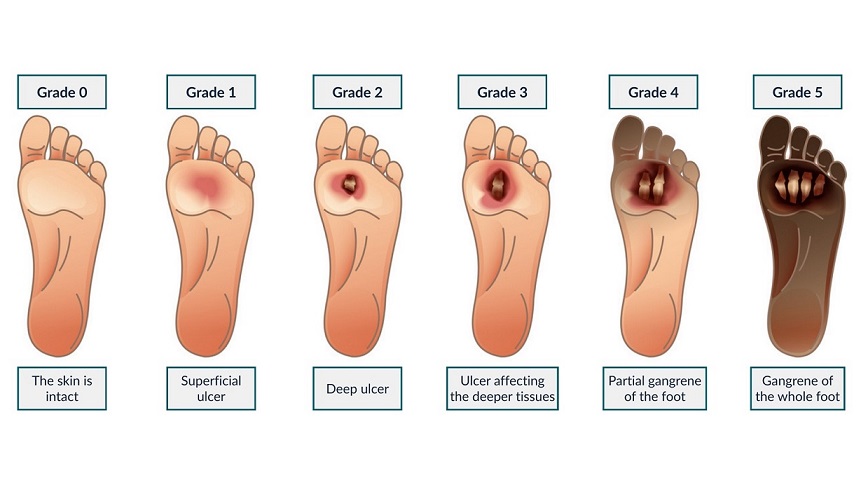 اینفوگرافیک مراحل ایجاد زخم دیابتی