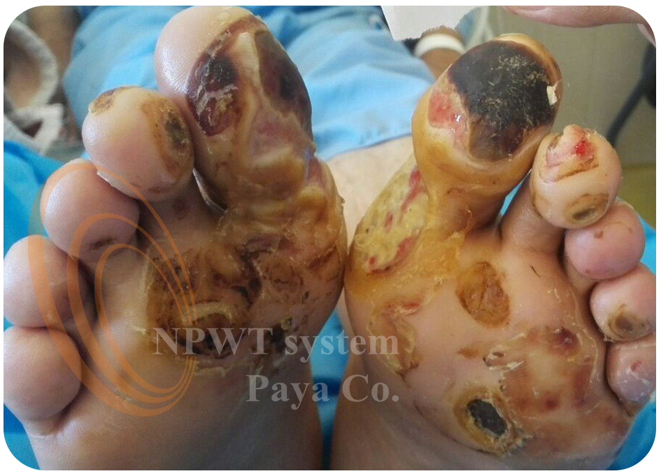 زخم پای دیابتی